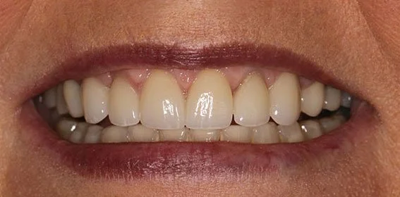 Close-up of a smiling mouth showing teeth and gums.