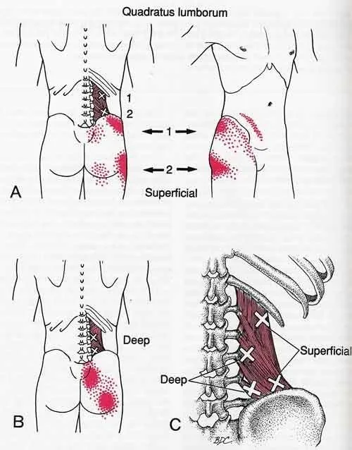 low back pain trigger points
