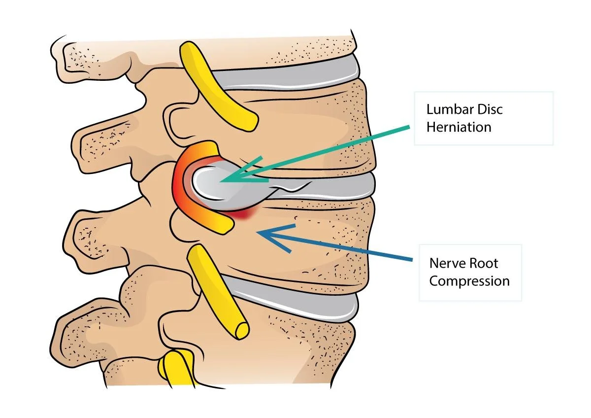 Diagram of a human spine showing a lumbar disc herniation causing nerve root compression with labels pointing to the herniation and nerve compression.
