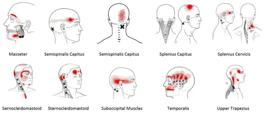 Diagram showing locations of pain or pressure points on the head and neck for various skull and muscle regions, including Masseter, Semispinalis Capitis, Splenius Capitis, Splenius Cervicis, Sernocleidomastoid, Suboccipital Muscles, Temporal, and Upper Trapezius.