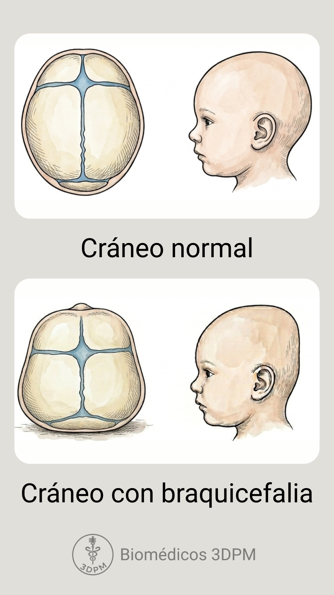 Ilustración comparativa del cráneo normal y el cráneo con braquicefalia, con vista superior y perfil de ambos.