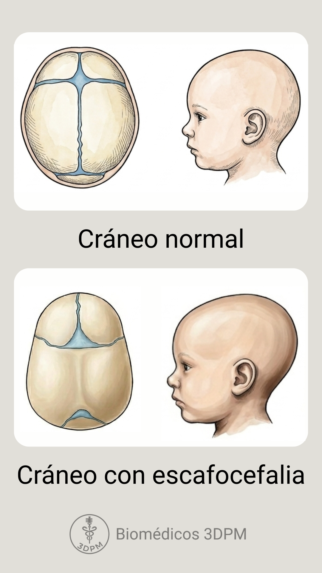 Comparación entre un cráneo normal y uno con escafocefalia, mostrando diferentes formas del cráneo en ilustraciones médicas.