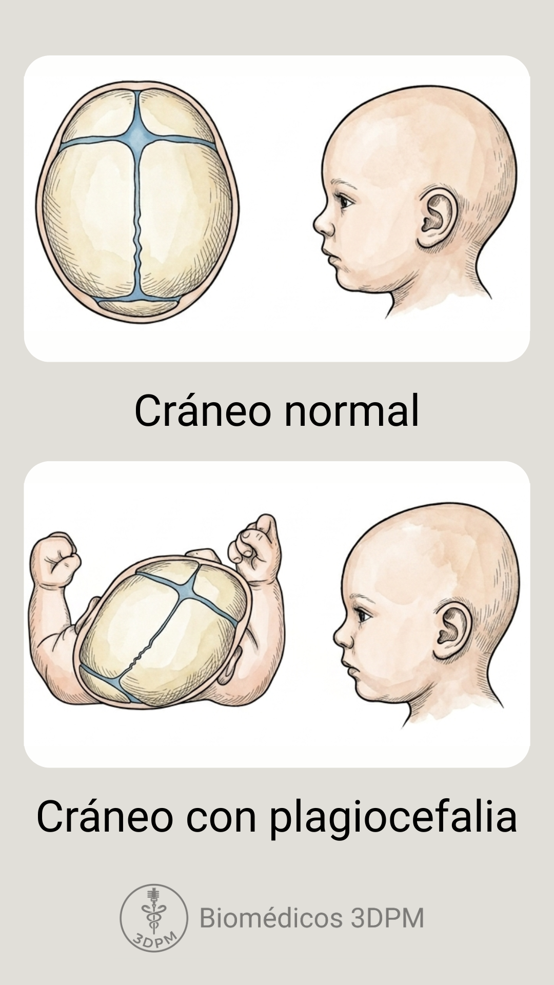 Comparación entre un cráneo normal y un cráneo con plagiocefalia, mostrando la diferencia en forma y tamaño de la cabeza en un niño.
