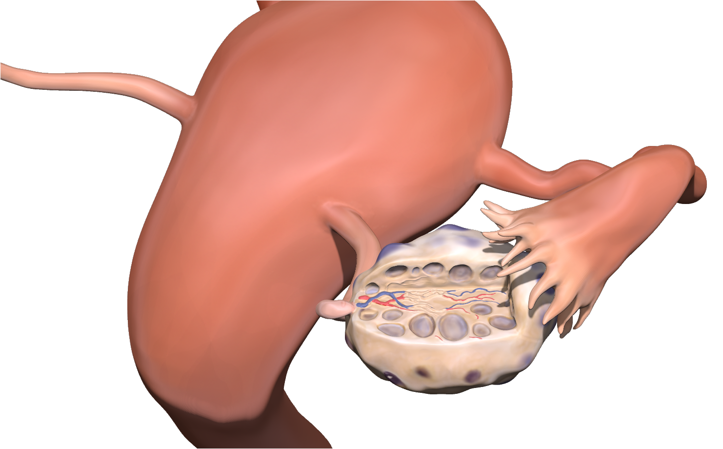 Process image of painting the PMOS-afflicted ovary in Zbrush using polypaint.