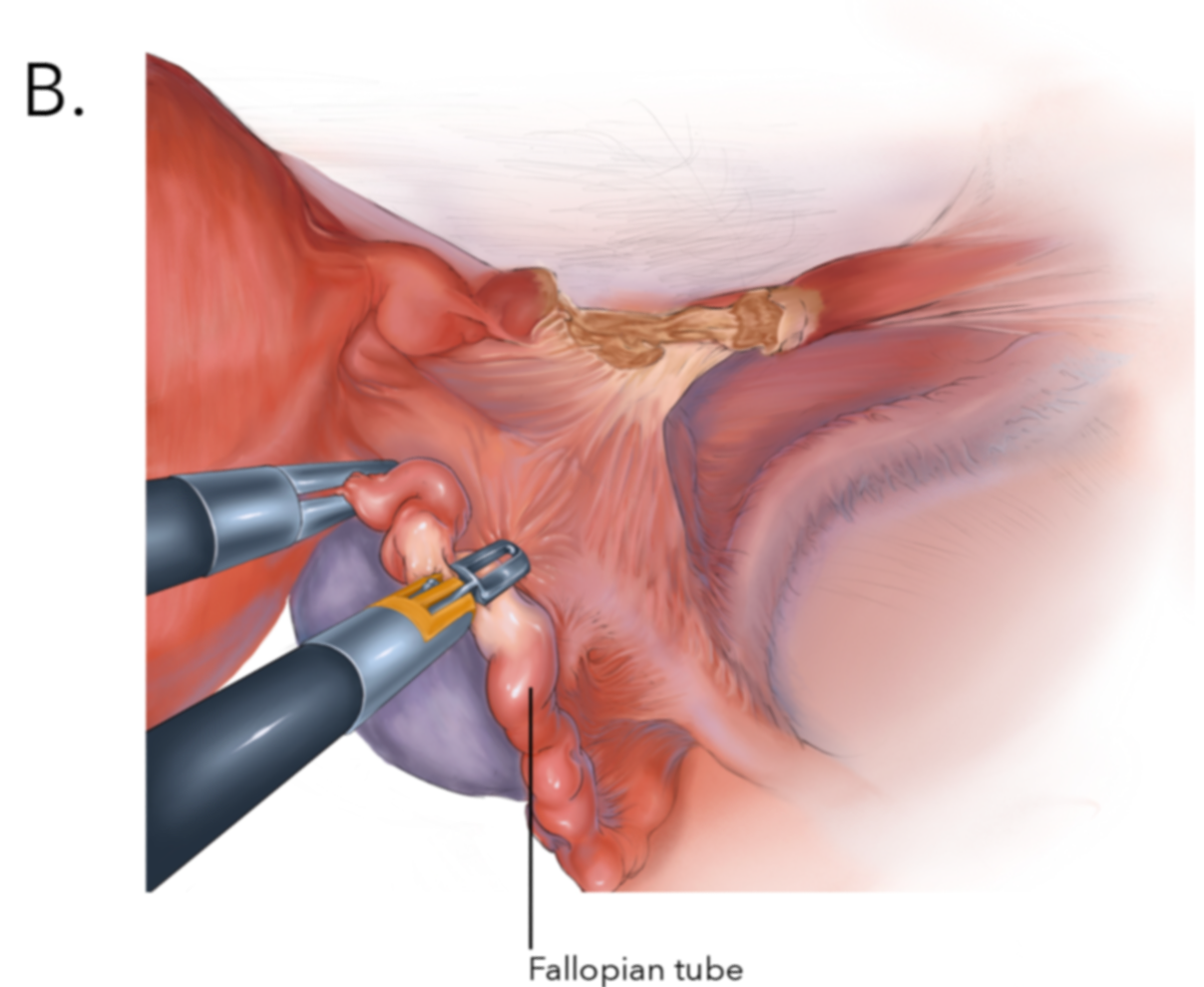 Laparoscopic Hysterectomy. Step B.