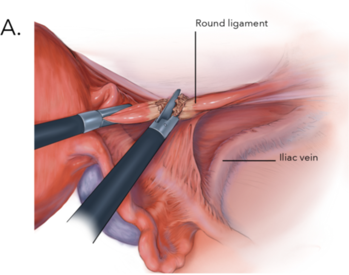 Laparoscopic Hysterectomy. Step A.