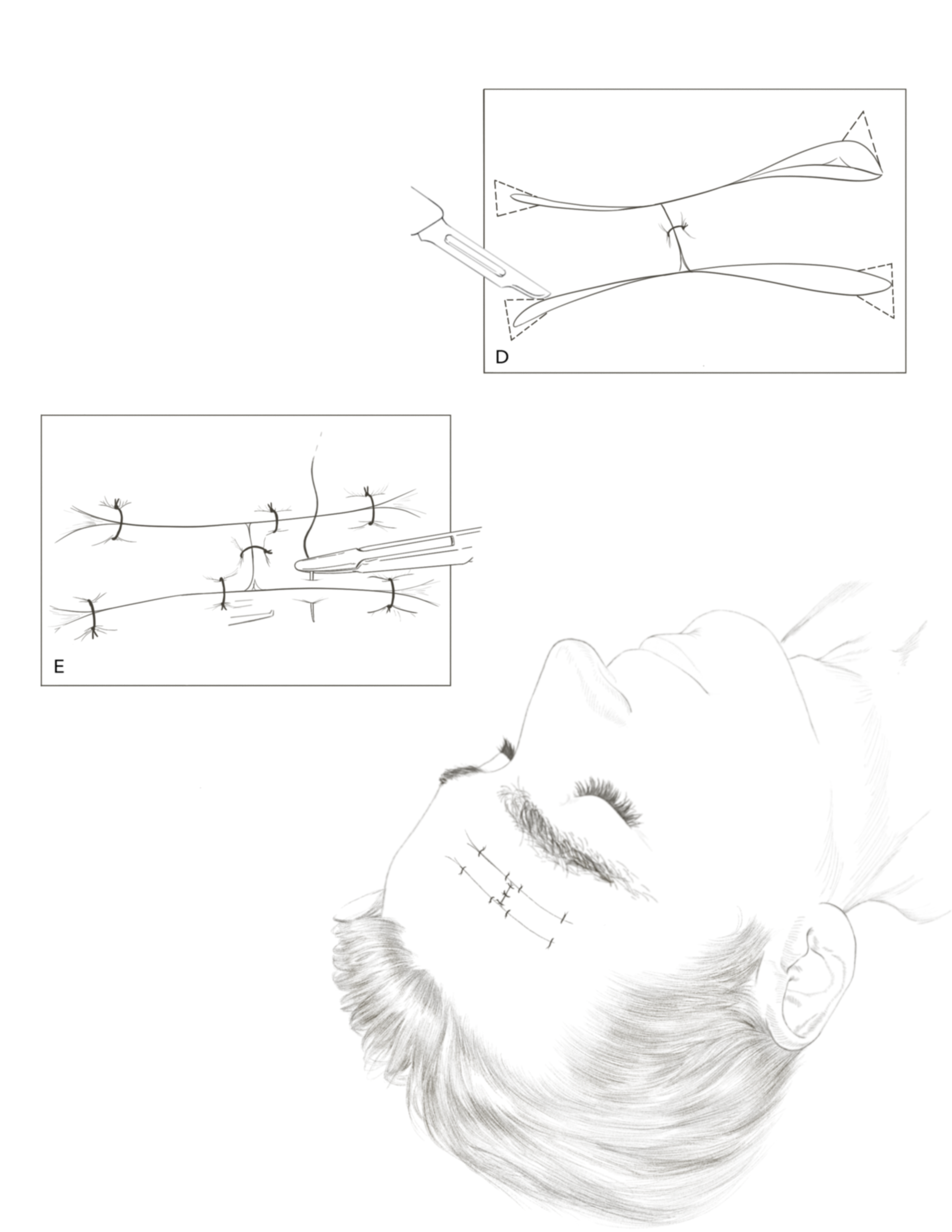 Partial steps of an H-Plasty surgery.