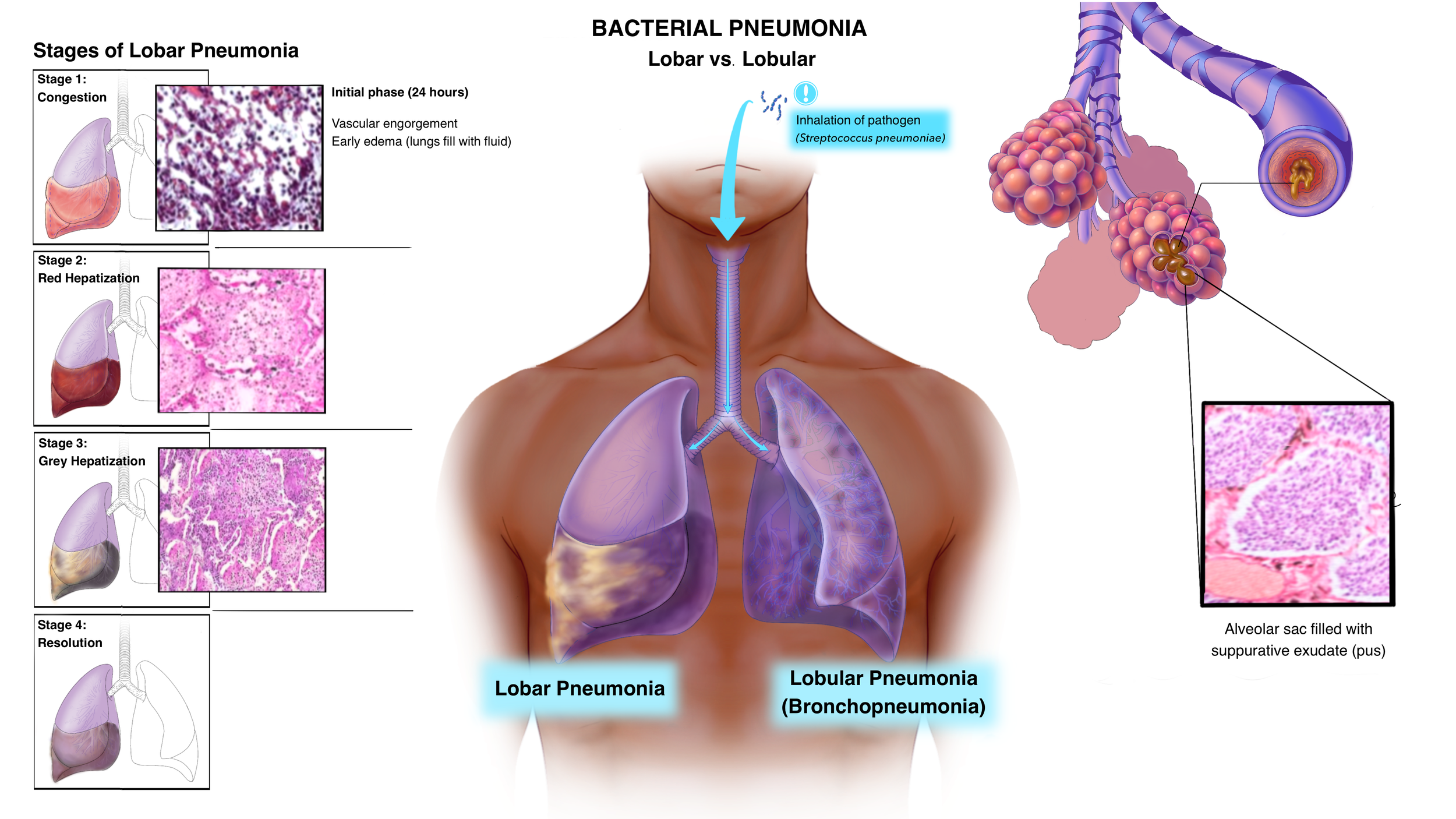 This piece was created for our graduate pathology course. The purpose was to illustrate the histological and gross anatomical differences between two bacterial pneumonias: lobar pneumonia and lobular pneumonia (bronchopneumonia). 
This piece was deve