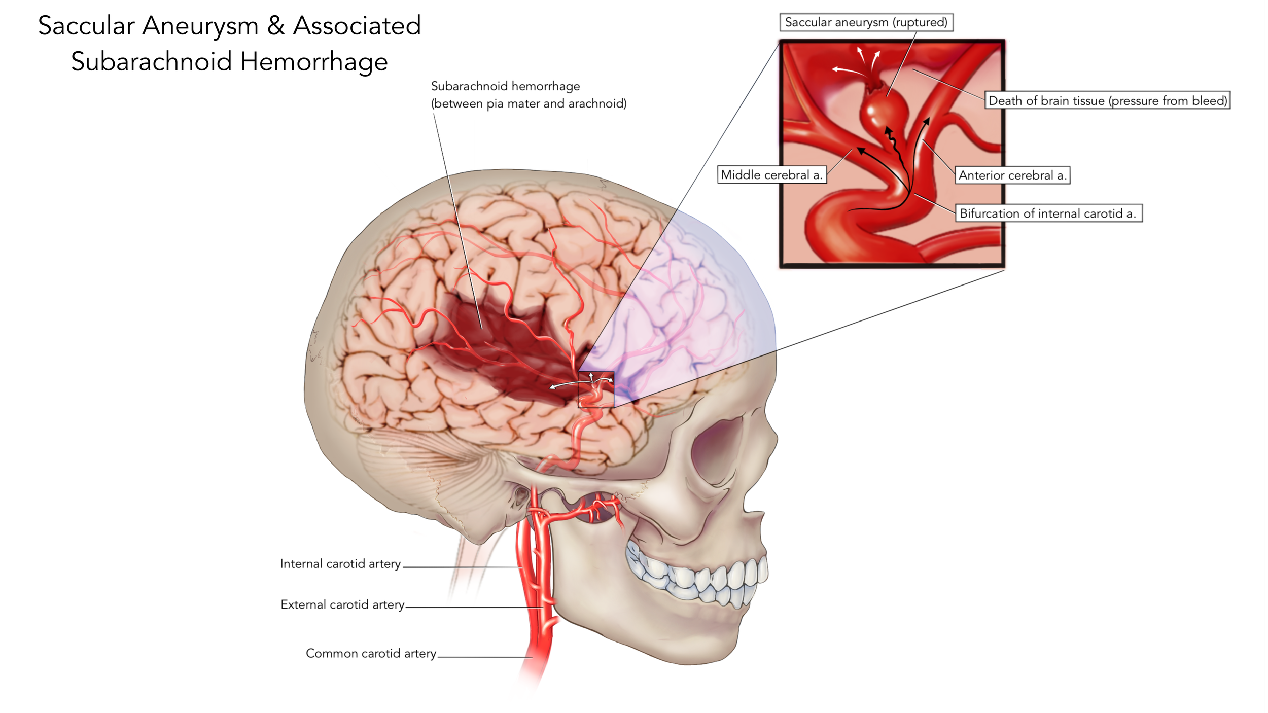 This piece was created for our graduate pathology course. The purpose was to illustrate the presentation of a saccular (berry) aneurysm and its resulting subarachnoid hemorrhage.
This piece was developed using Photoshop and Illustrator.
