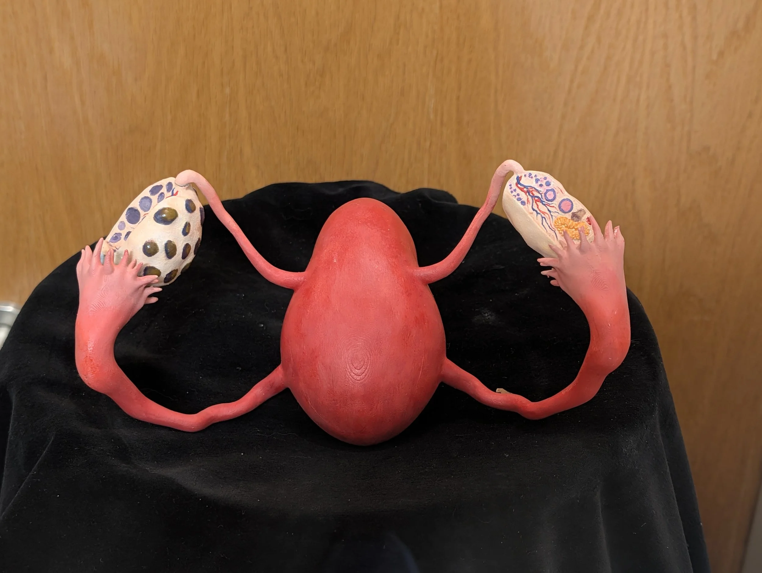 3D printed uterus showcasing standard anatomy of ovary vs ovary of an individual with PMOS (formerly PCOS). 