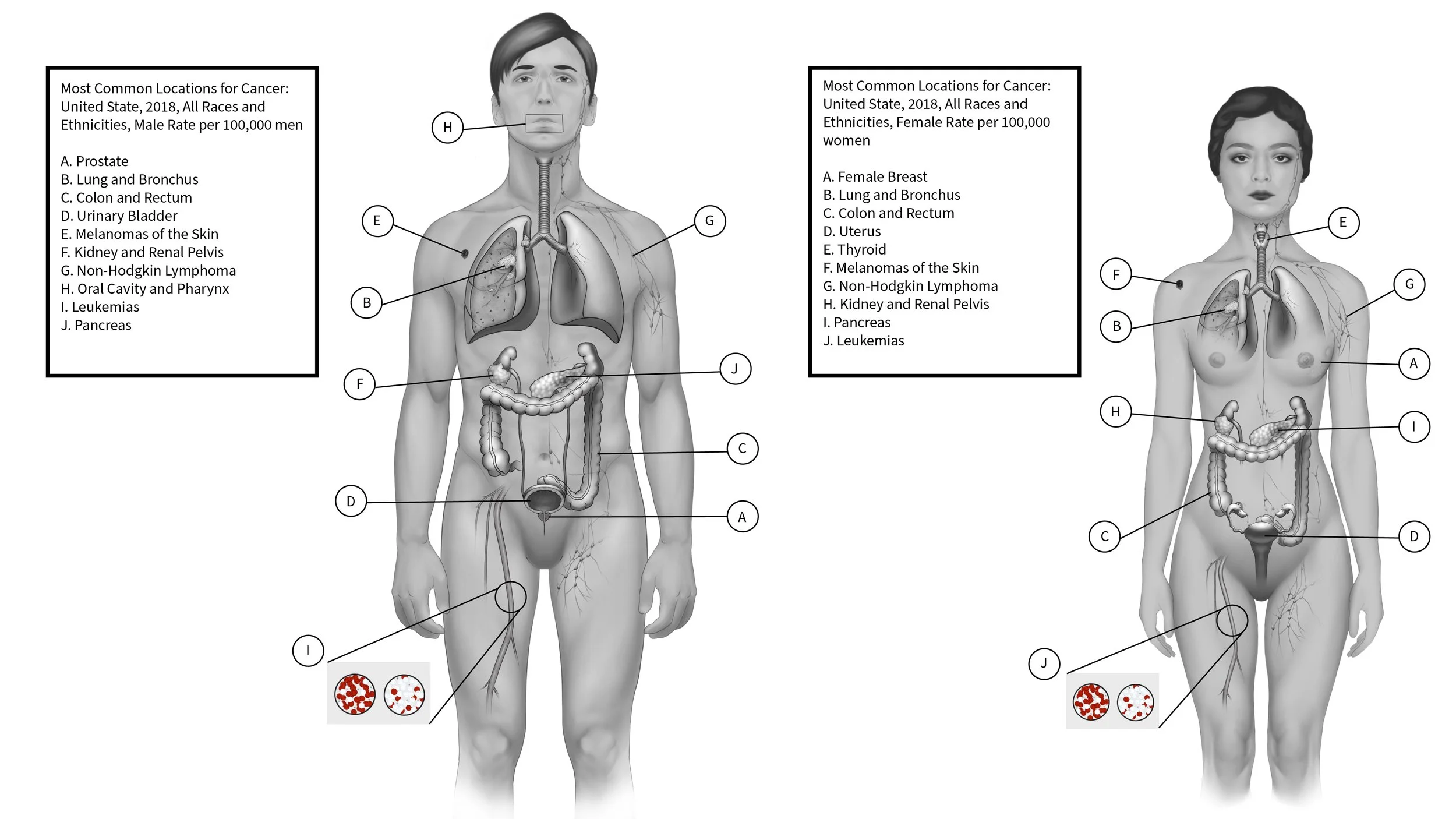 This piece was created for our graduate pathology course. The purpose was to depict the ten most common locations of cancer between men and women. 
This piece was developed using Photoshop and Illustrator.
