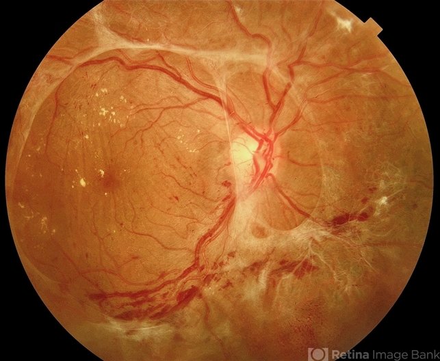 RDP, retinopatía diabética, desprendimiento de retina, diabetes