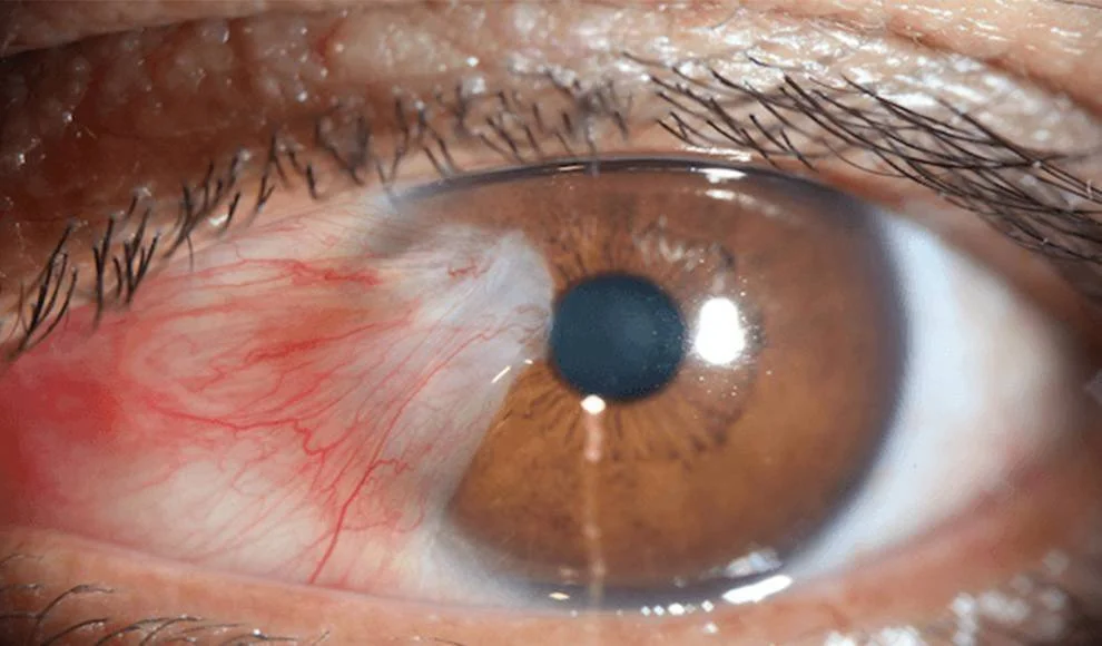 Pterigium_original.jpg