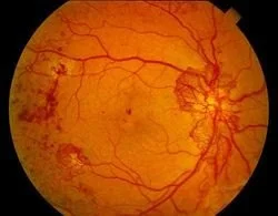 Retinopatía diabetica