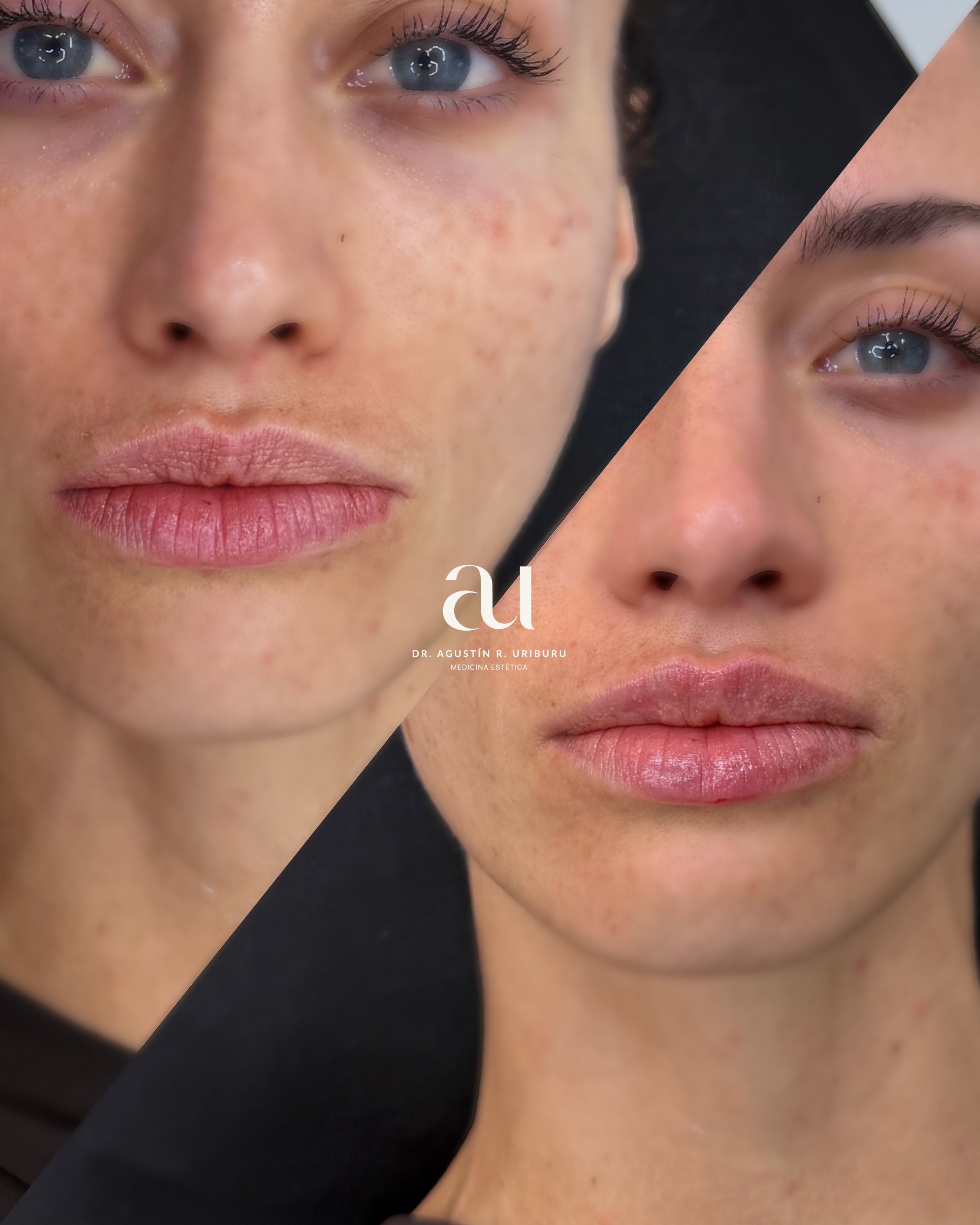 Modelo con tratamiento de labios con acido hialuronico, resultado sutil, elegante y personaliazdo.