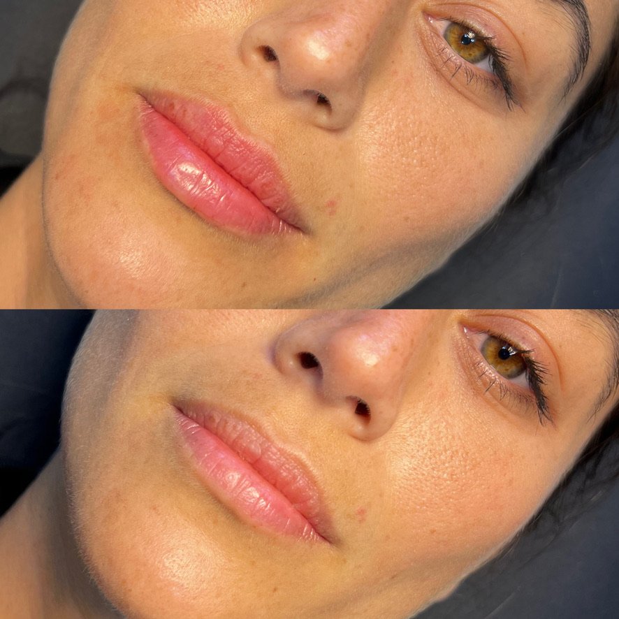 Aumento de labios con ácido hialurónico: cuando la medicina estética se convierte en arte