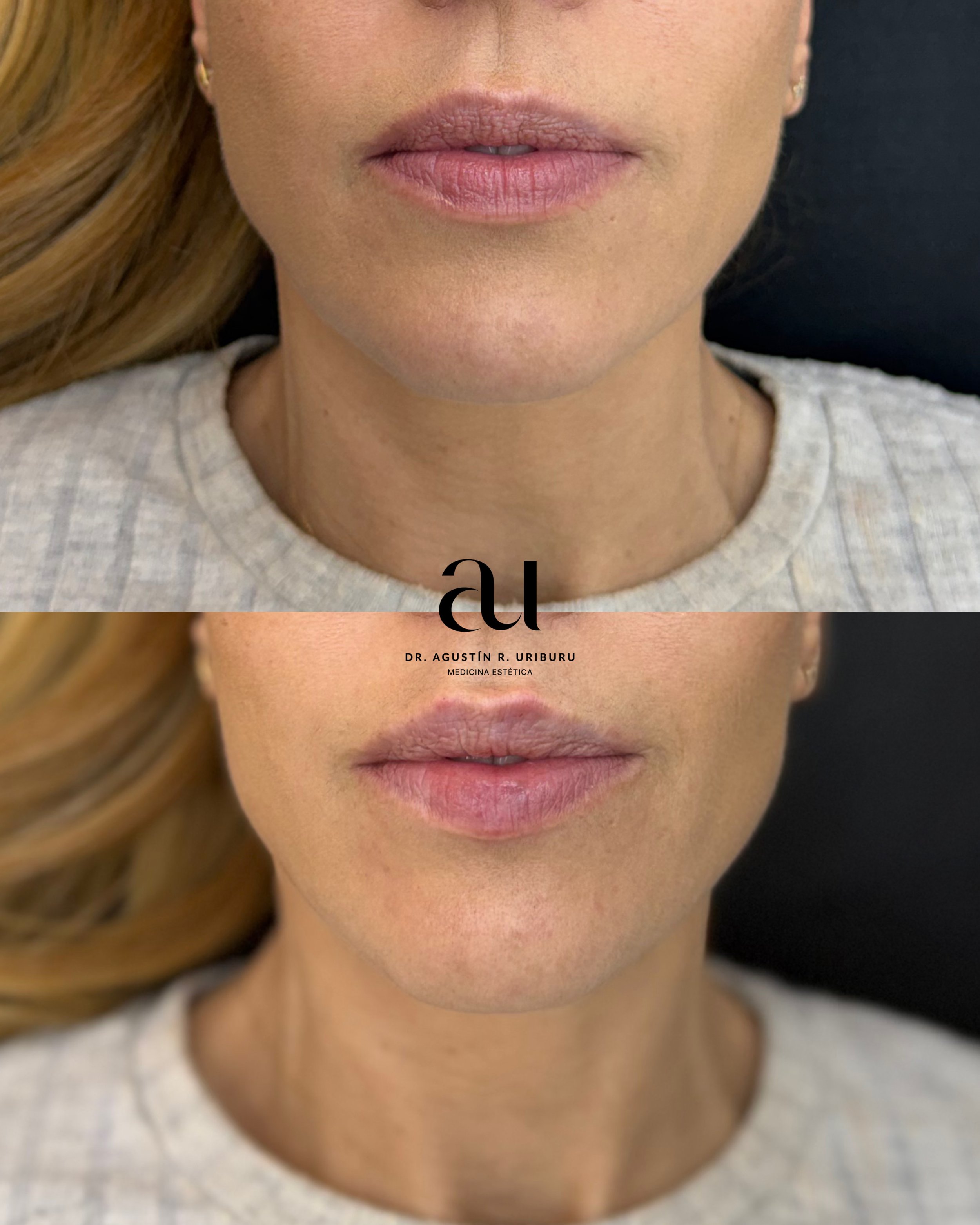 Dr. Uriburu, especialista en labios. 