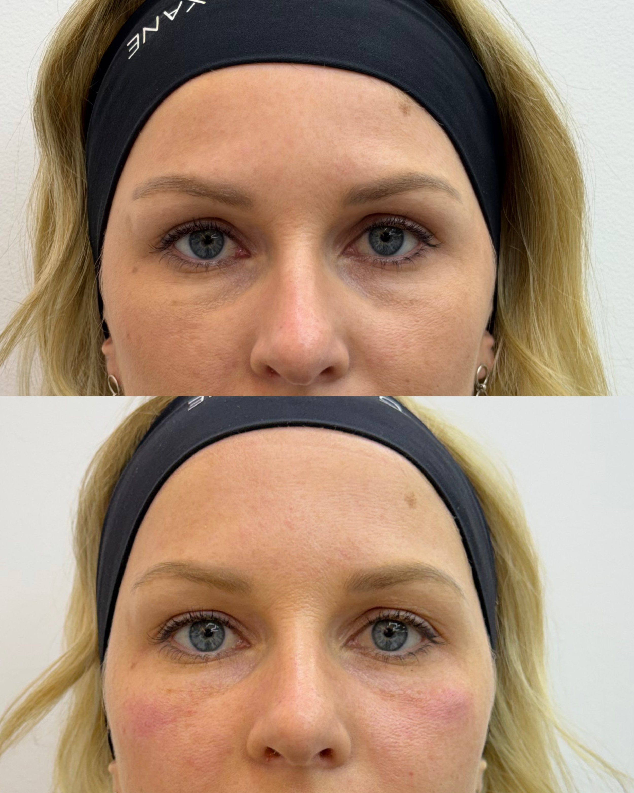 Tratamiento de ojeras con ácido hialurónico en Barcelona.