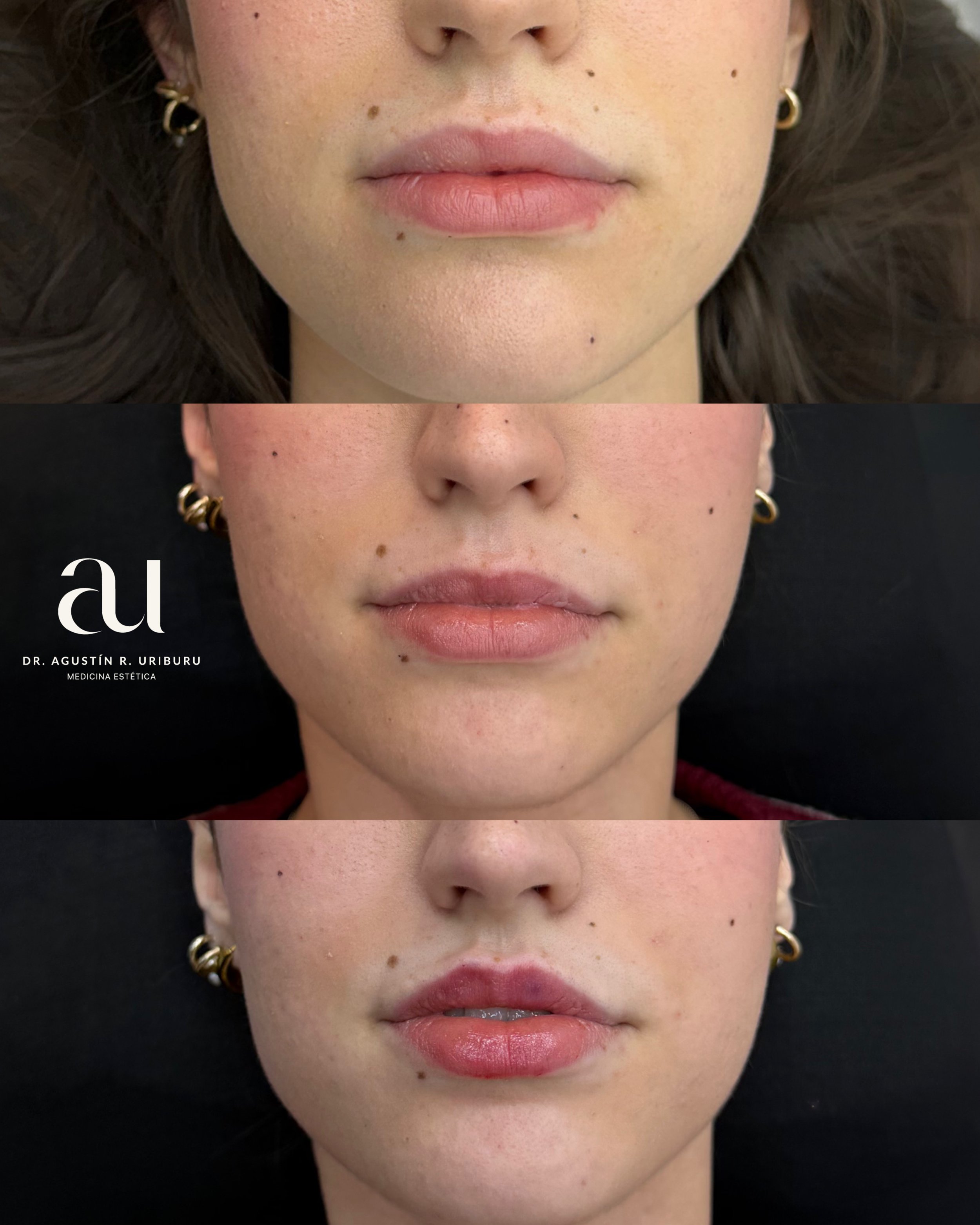 Retirada de ácido hialurónico y producto migrado. Barcelona | Dr. Uriburu