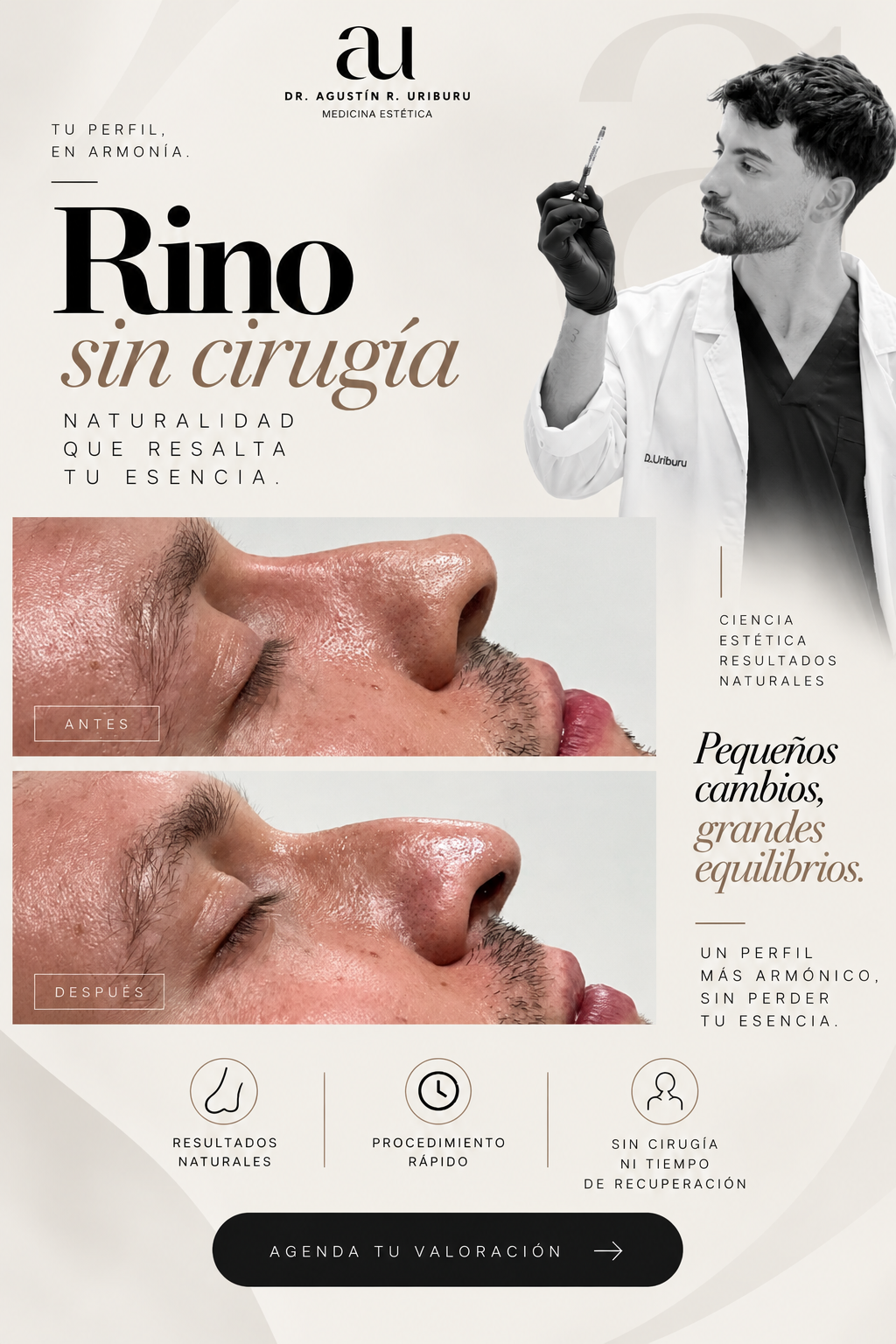 Rinomodelación en Barcelona: cómo mejoro el perfil de la nariz sin cirugía