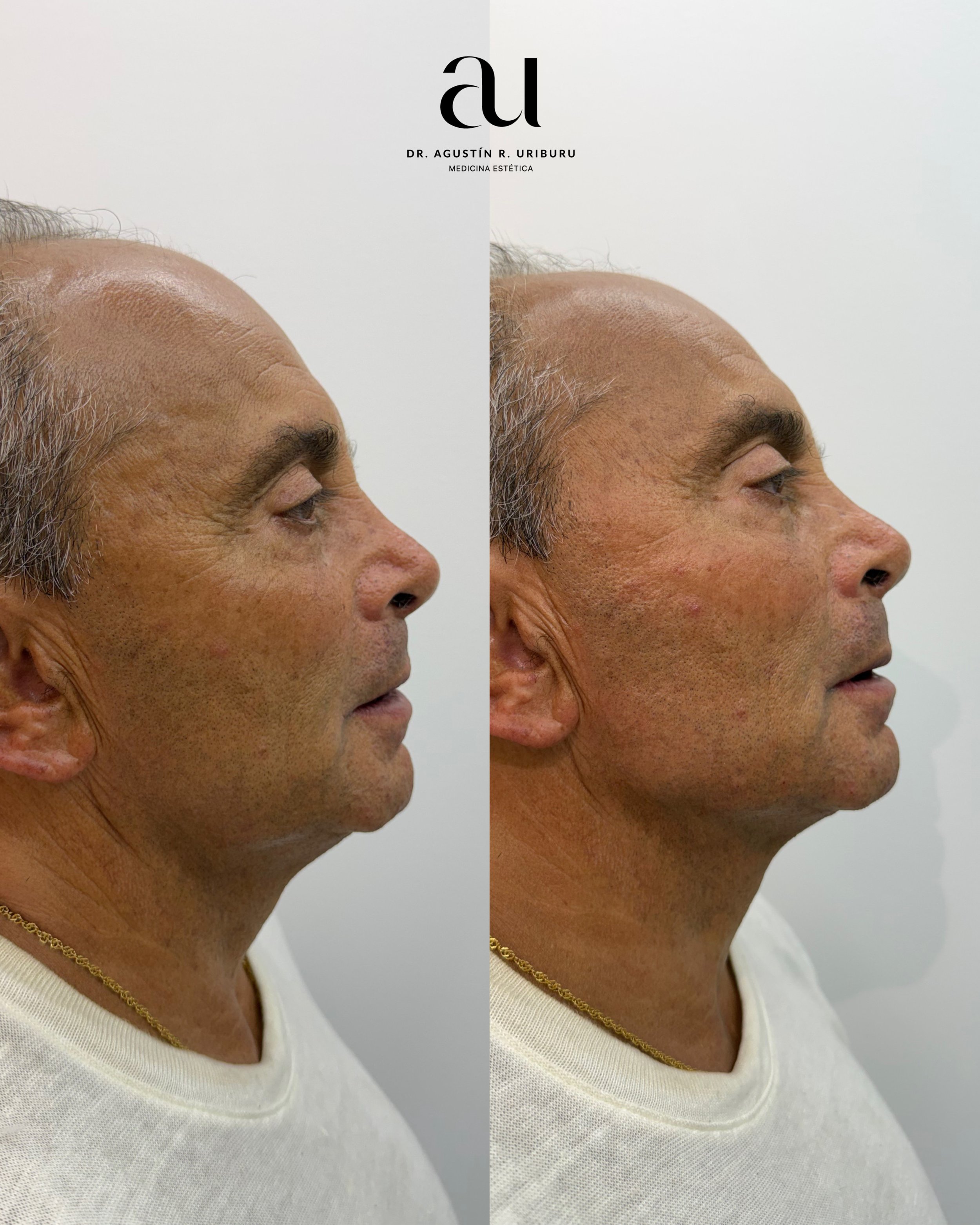 Perfilado mandibular en Barcelona: un óvalo facial más definido sin cirugía