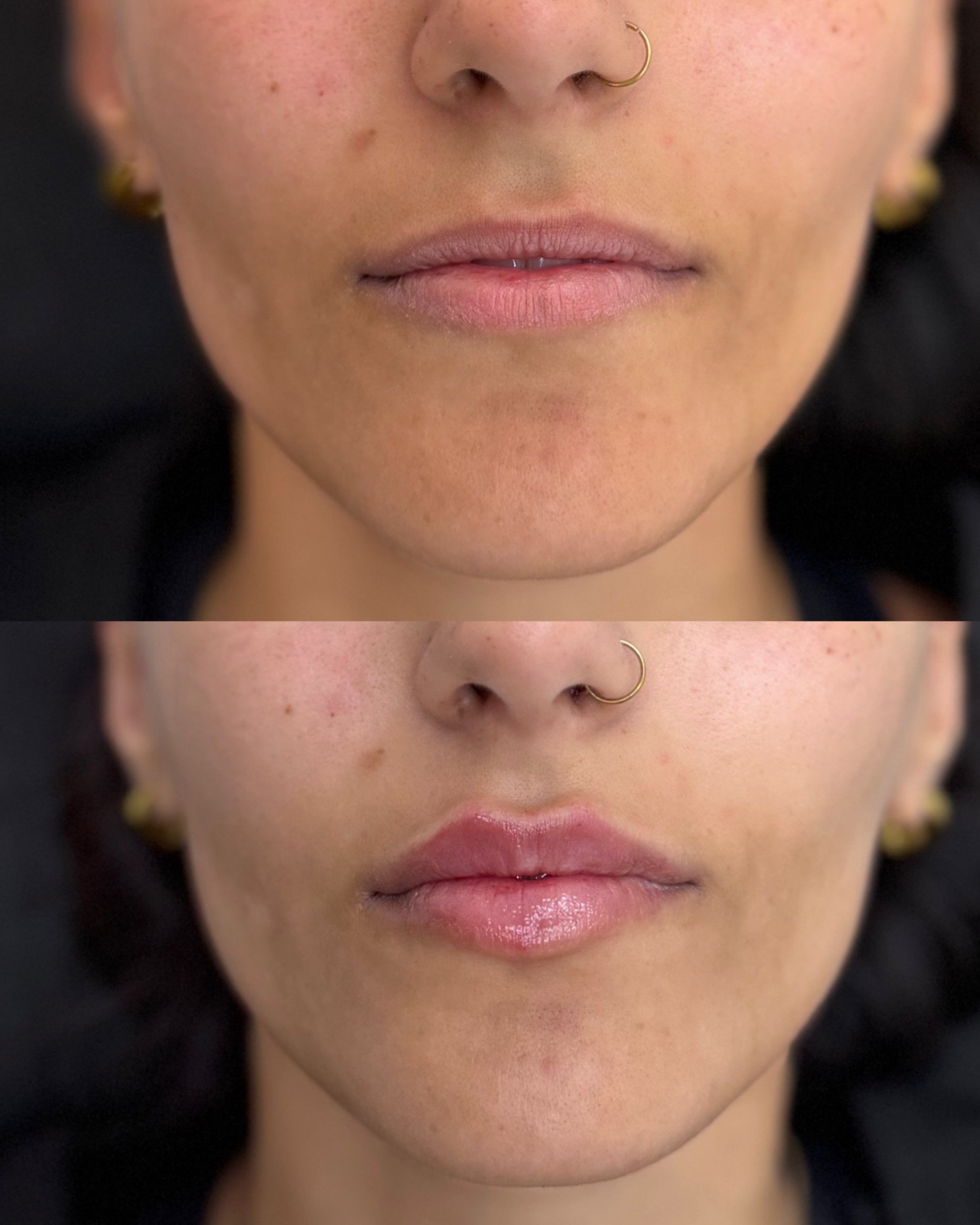 Antes y despues de tratamiento de labios, luego de realizar retirada de producto migrado. Resultado natural, elegante y excelente.