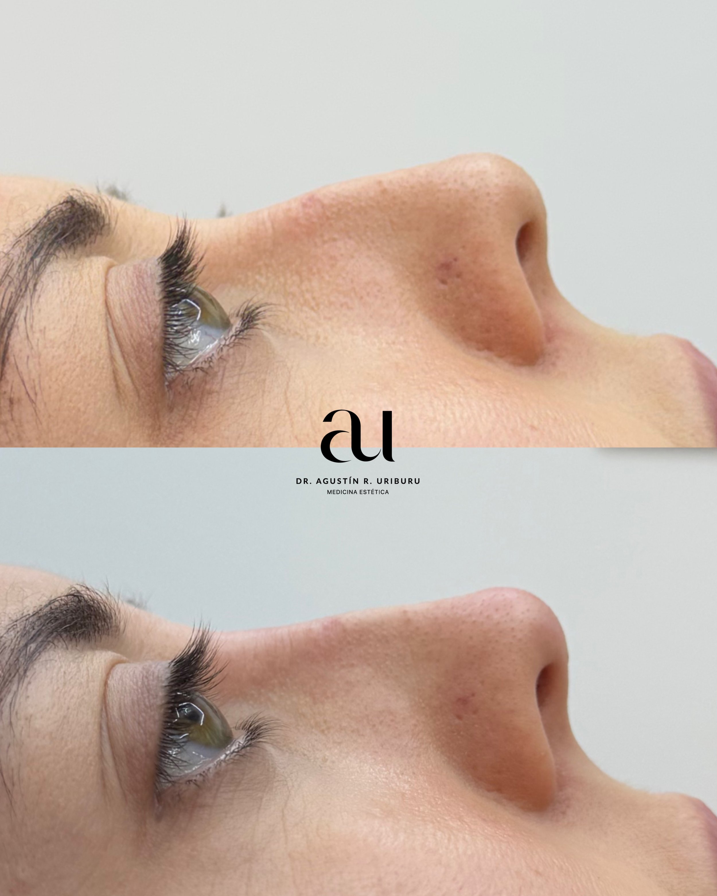 Antes y despues rinoplastia sin cirugia, resultado elegante y natural de una chica que no le gustaba su forma, ahora se la ve mas feliz, segura y armonía en perfil