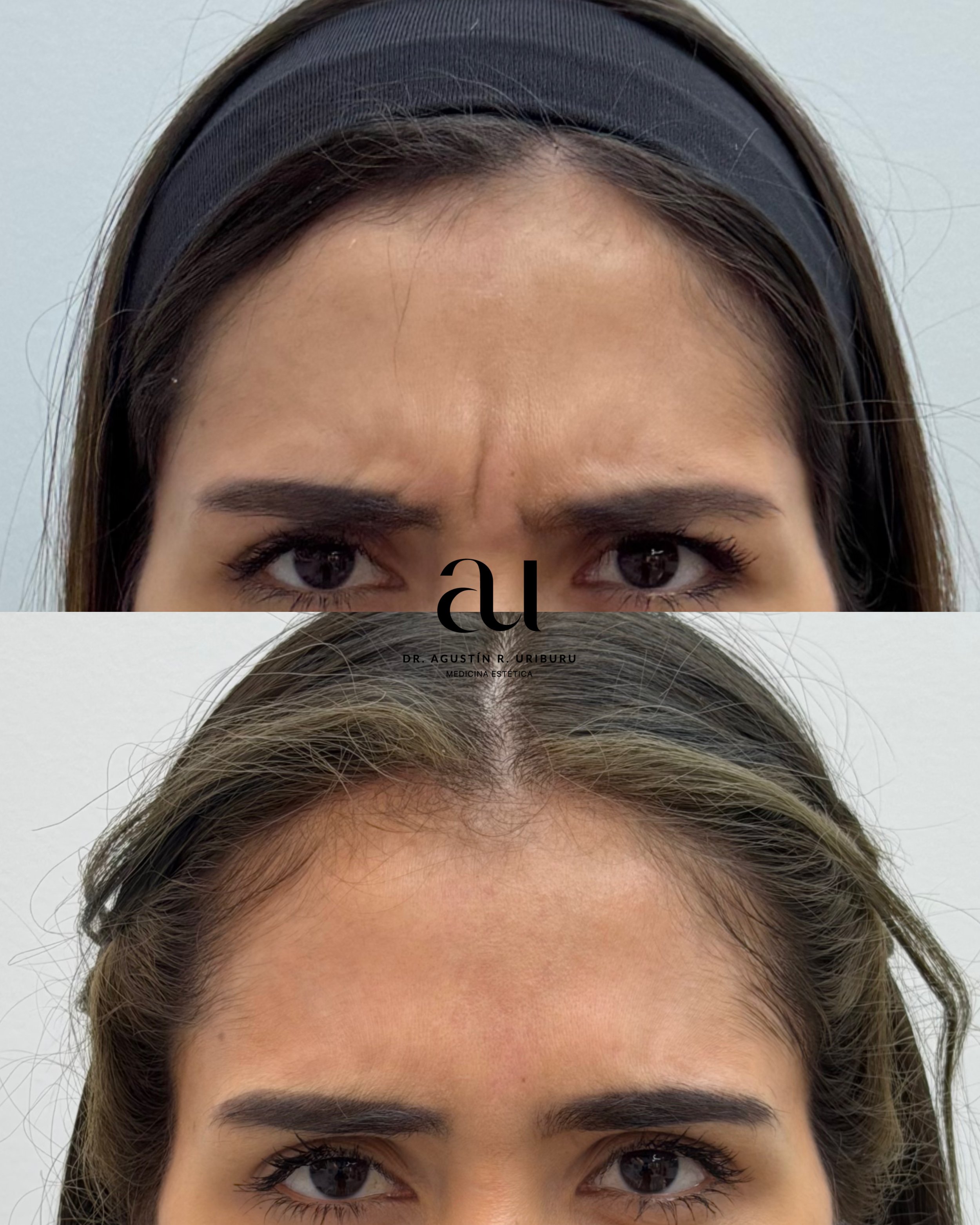 Tratamiento con neuromoduladores en tercio superior completo, sin arrugas, natural y sin perder expresion