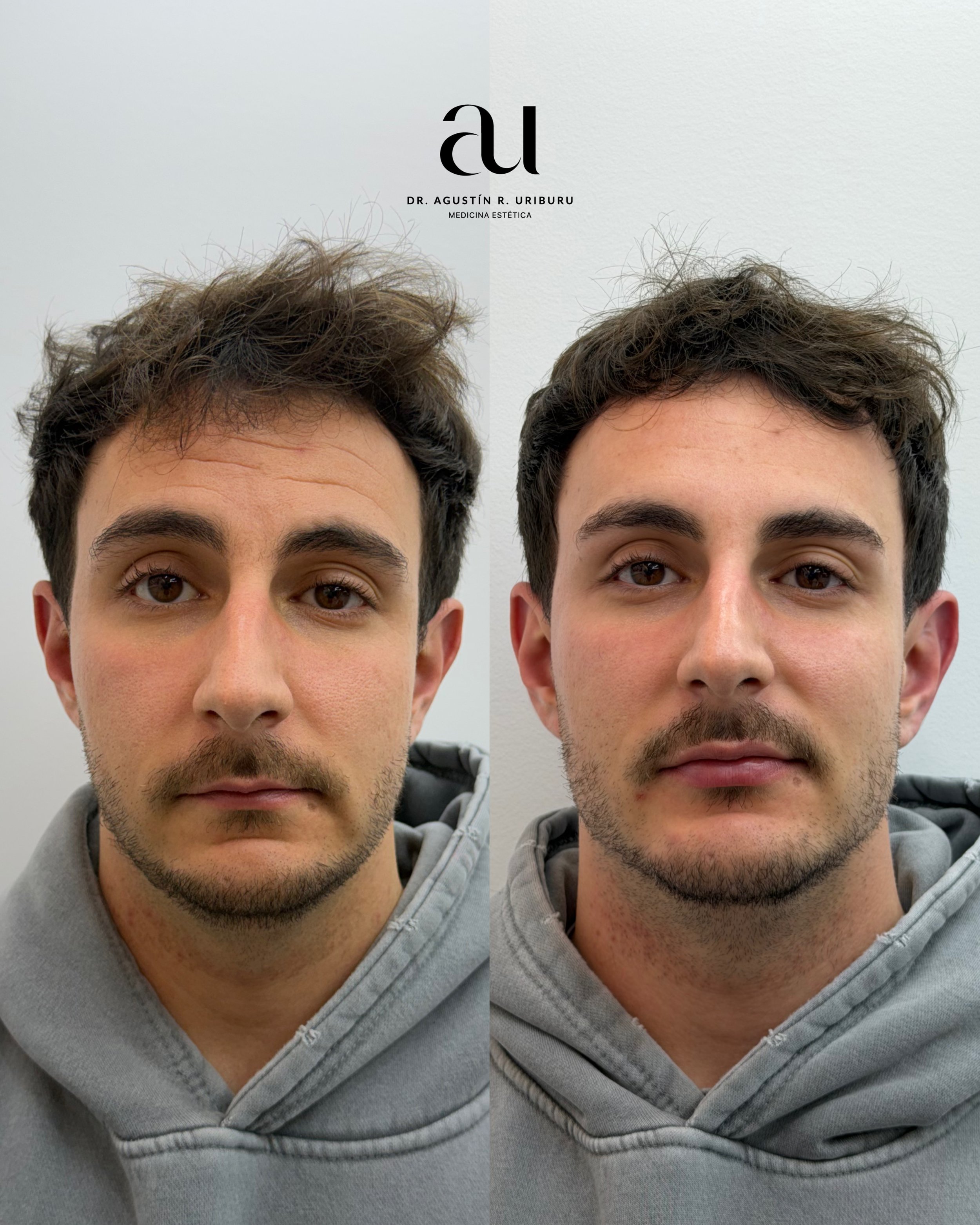 Masculinización facial: definición estructural, proyección y equilibrio con resultados naturales.
