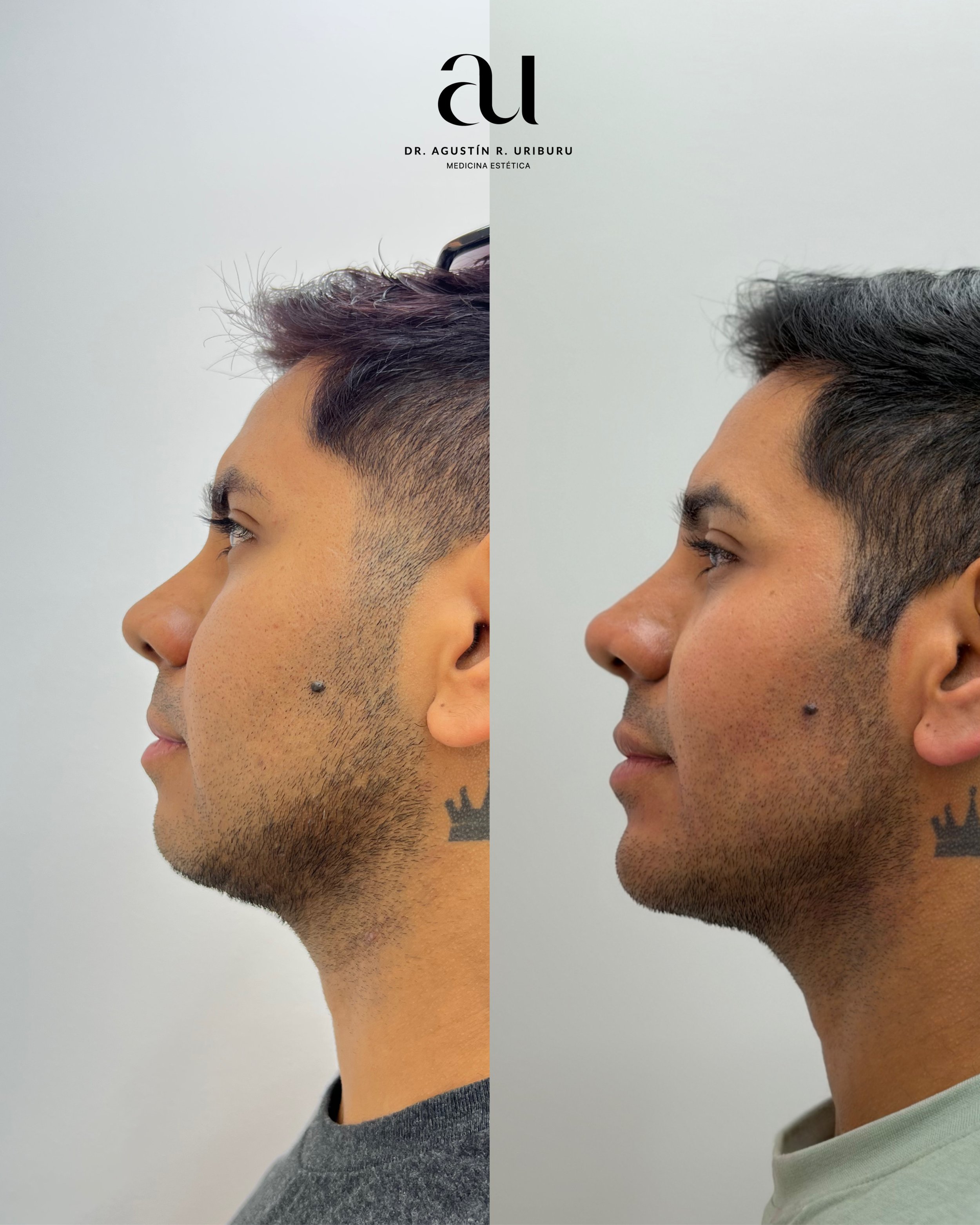 Antes/después de armonización facial sin cirugia, con resultado elegante y natural.