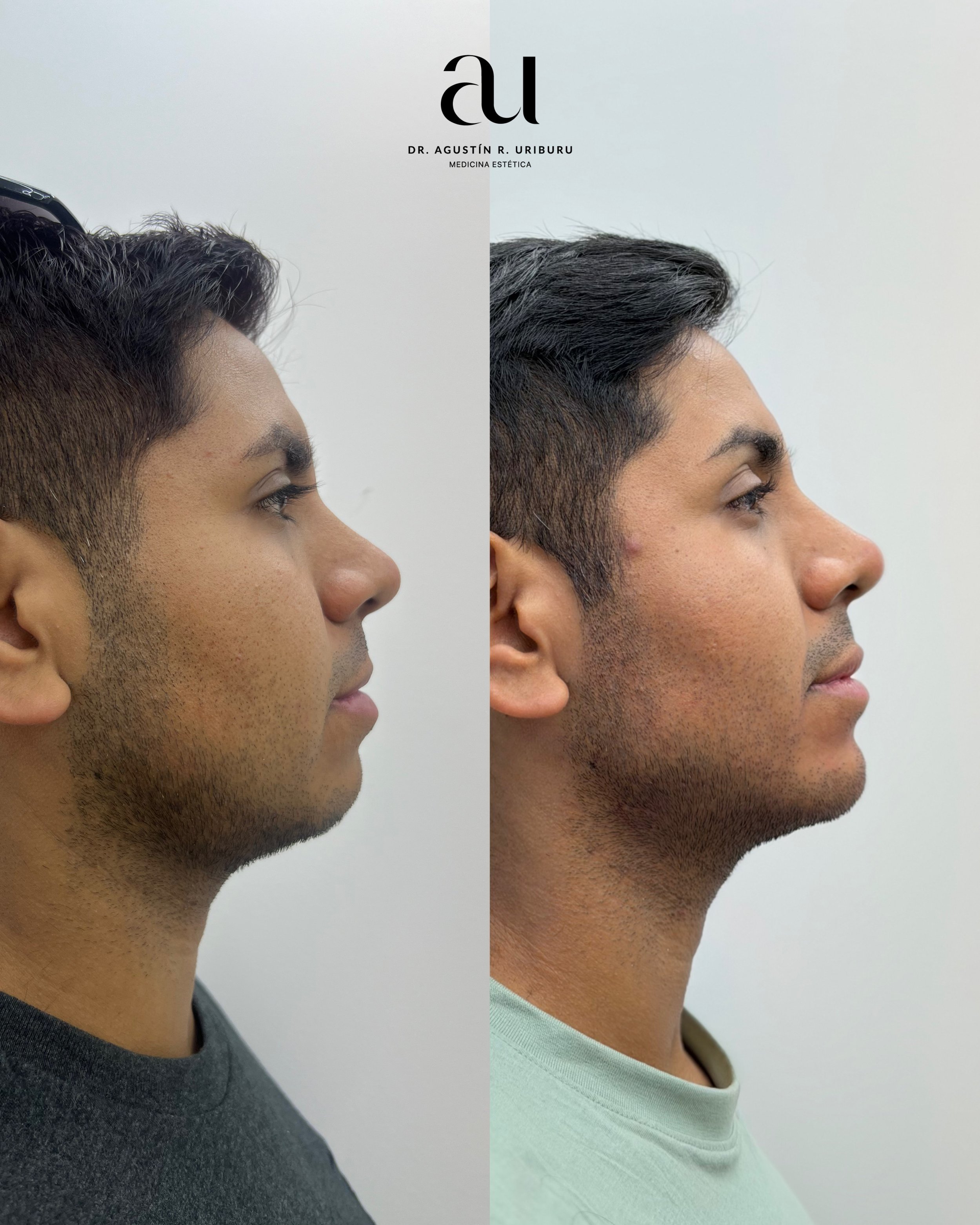Comparación antes y después de una mejora en la apariencia del cabello y la línea del cabello en un hombre, con texto en la parte superior que dice 'AI' y el nombre del doctor Agustín R. Uriburu relacionado con medicina estética.