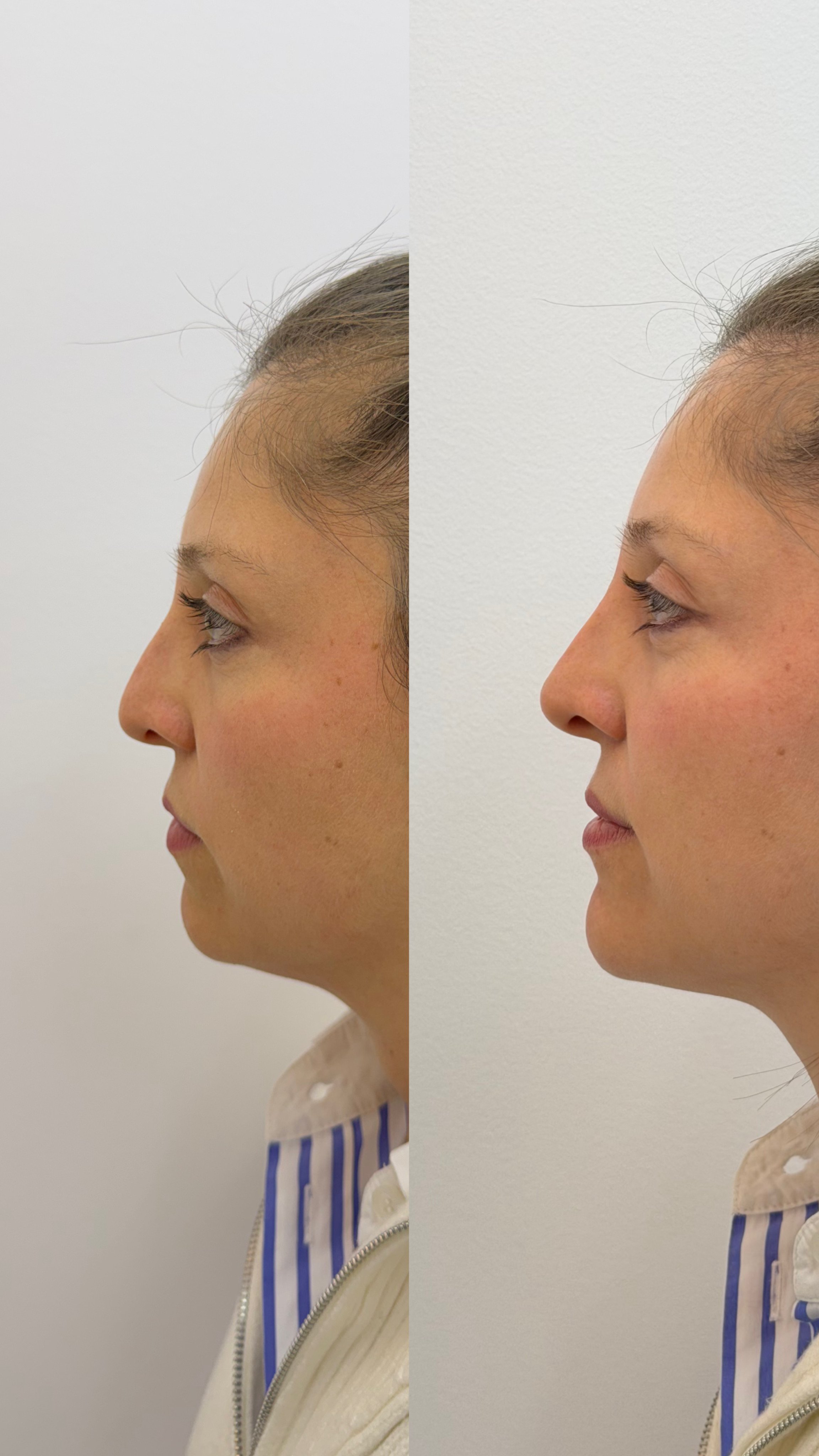 Rinomodelación: equilibrio, proyección y armonía sin cirugía.