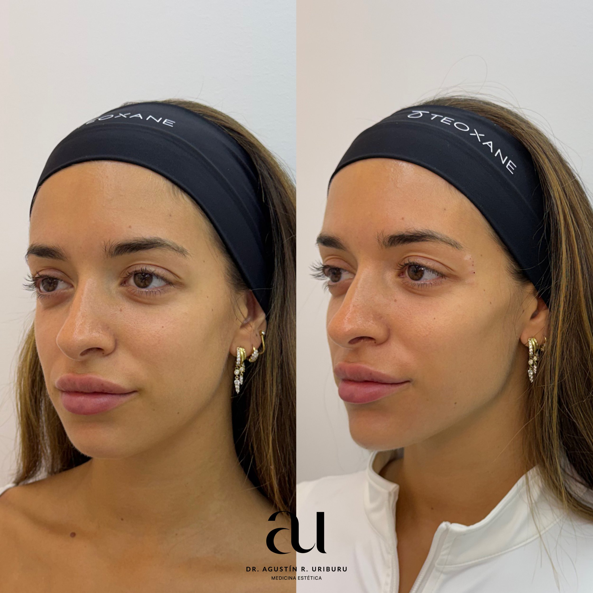 Armonización y rejuvenecimiento facial: equilibrio, frescura y naturalidad