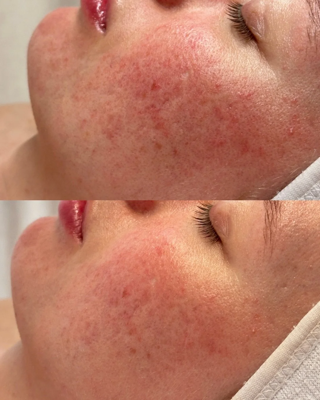 These results are after just ONE session 👏🏼

We combined a pro calm 60 treatment using @dermalogicapro range with @dermaluxled phototherapy - both completely tailored to her skin&rsquo;s needs. She has previously received Dermalux treatments and no