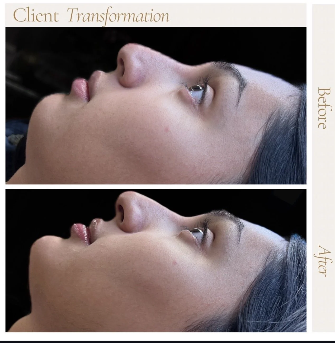 Side-by-side comparison of a woman's face before and after a transformation. The 'Before' shows a natural appearance, while the 'After' shows smoother skin with a more refined look. Med Spa in Fishers, IN | B Beauty Aesthetics