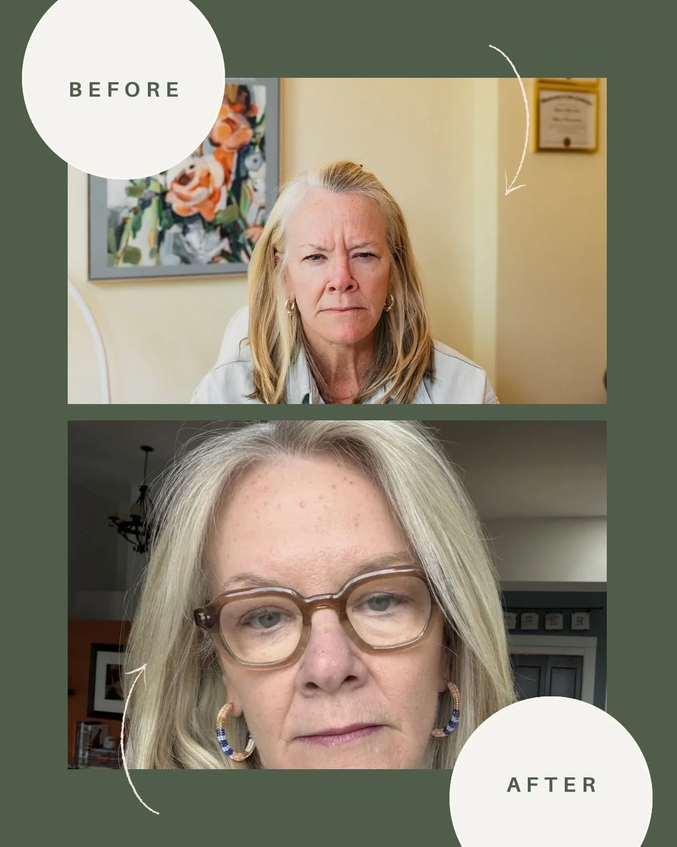 ✨ Natural, refreshed, and still beautifully you. ✨

This lovely client wanted to soften forehead and frown lines while maintaining natural expression, and the results speak for themselves. 💛

Subtle enhancements can make a big difference in how you 