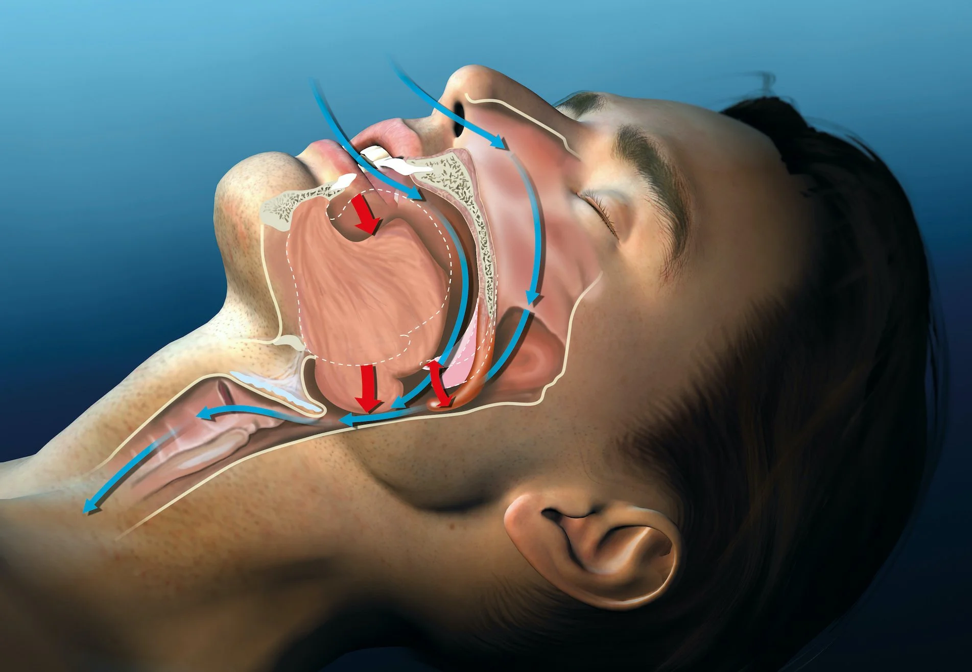 Sleep snoring anatomy illustration_6.jpeg