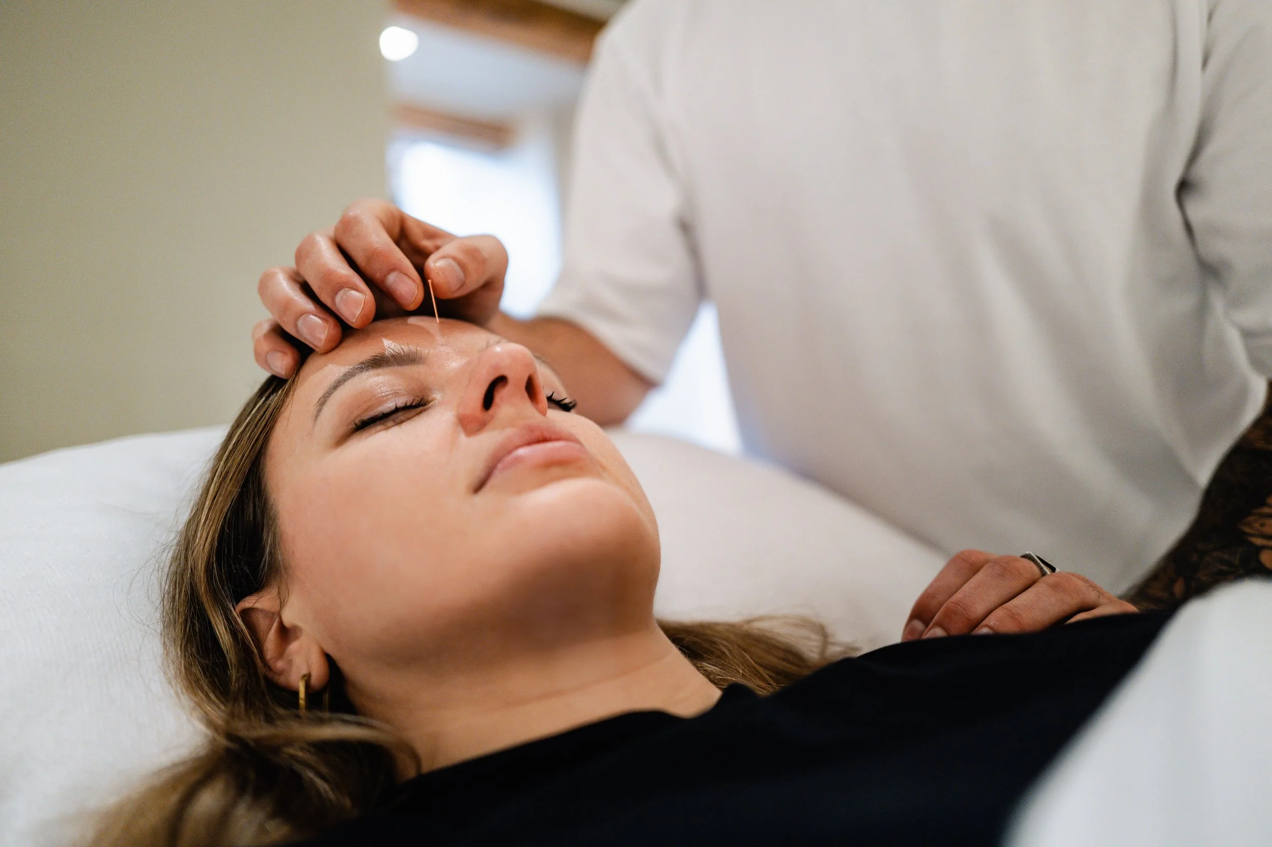 A woman lying on a treatment table with her eyes closed, receiving acupuncture, while a practitioner uses acupuncture needles on her face and forehead.