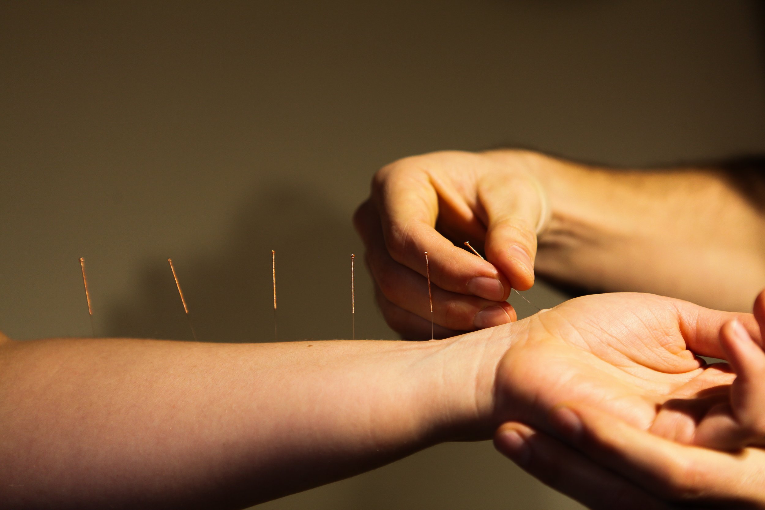 Acupuncture needles already inserted along the arm using Balance Method.