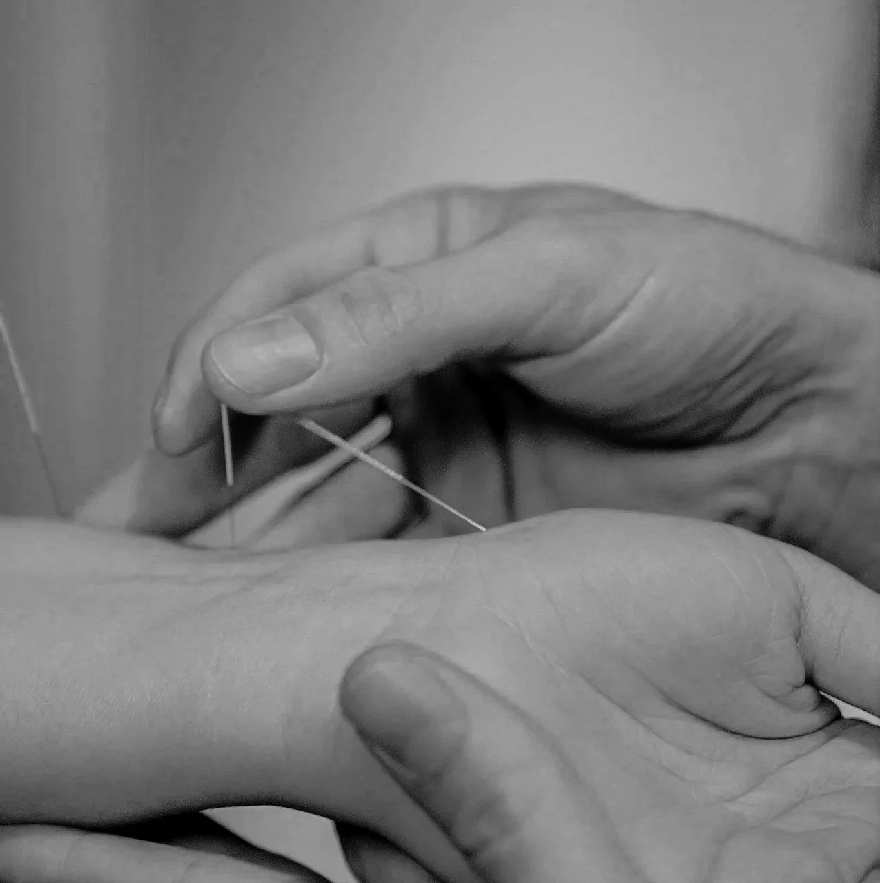 Acupuncture in Amsterdam