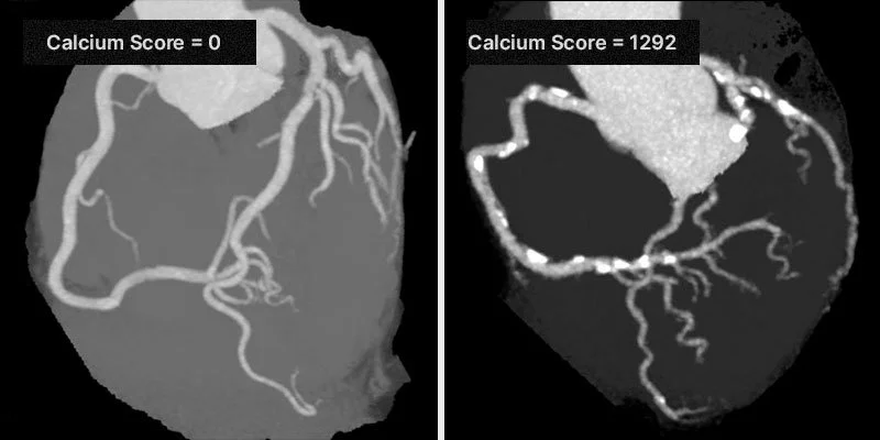 When should you actually get a coronary calcium score?