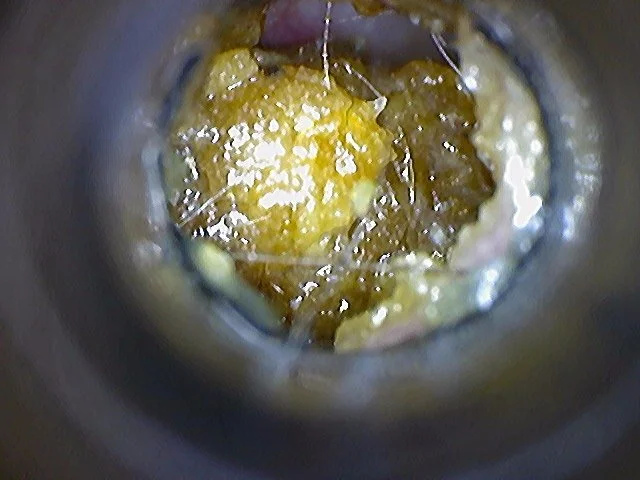 Client 1 - Before: Soft to semi-solid impacted earwax with entrapped hairs and skin debris causing near complete occlusion of the external auditory canal.