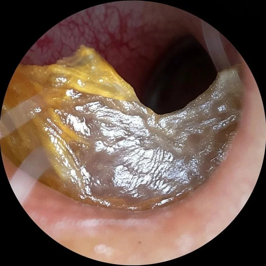 Before microsuction ear wax removal showing a large wall of earwax blocking the ear canal and trapping water behind it after swimming.