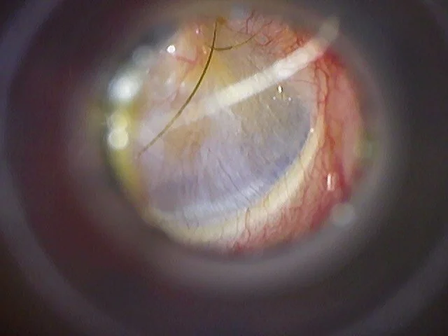Client 1 - After: Complete removal of earwax removed. The ear canal is clear and the ear drum appears healthy and intact.