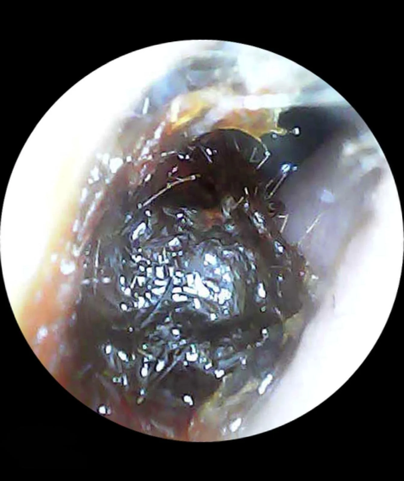 Client 3 - Before: Long-term itching was caused by a large build-up of impacted earwax deep within the ear canal, trapping hairs and irritating the sensitive skin.
