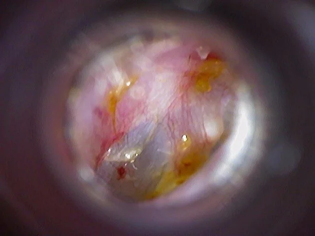Client 2 - After: The blockage has been safely removed, restoring a clear ear canal and allowing full visualisation of the eardrum.