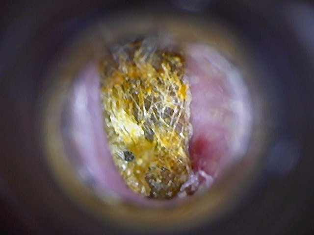 Client 2 - Before: A dense, impacted keratinous/waxy plug with significant debris entrapped within it. Likely hair, cotton fibres from earbuds/cotton wool or skin debris trapped in the earwax.