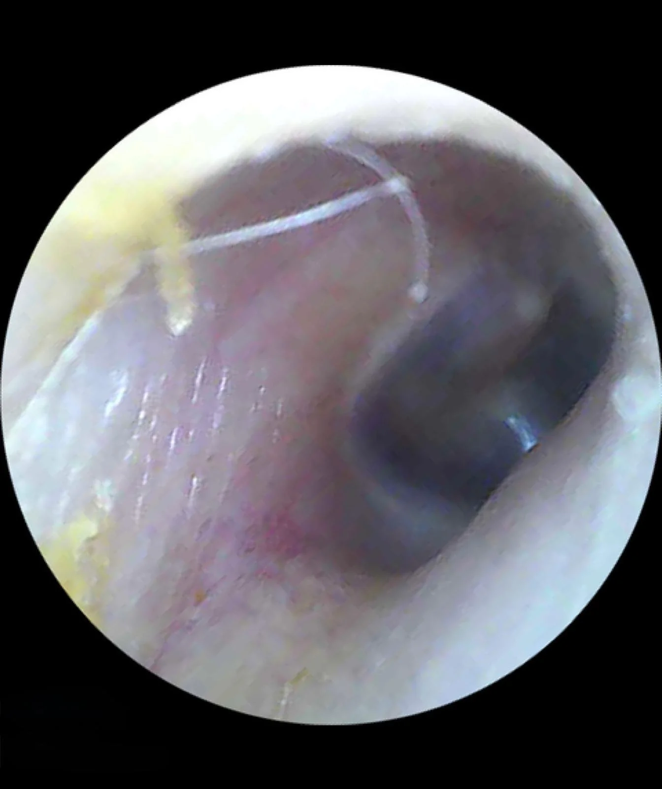 Client 3 - After: The ear canal was successfully cleared, restoring a healthy appearance. The client reported immediate relief, with the ear feeling cleaner and more comfortable.