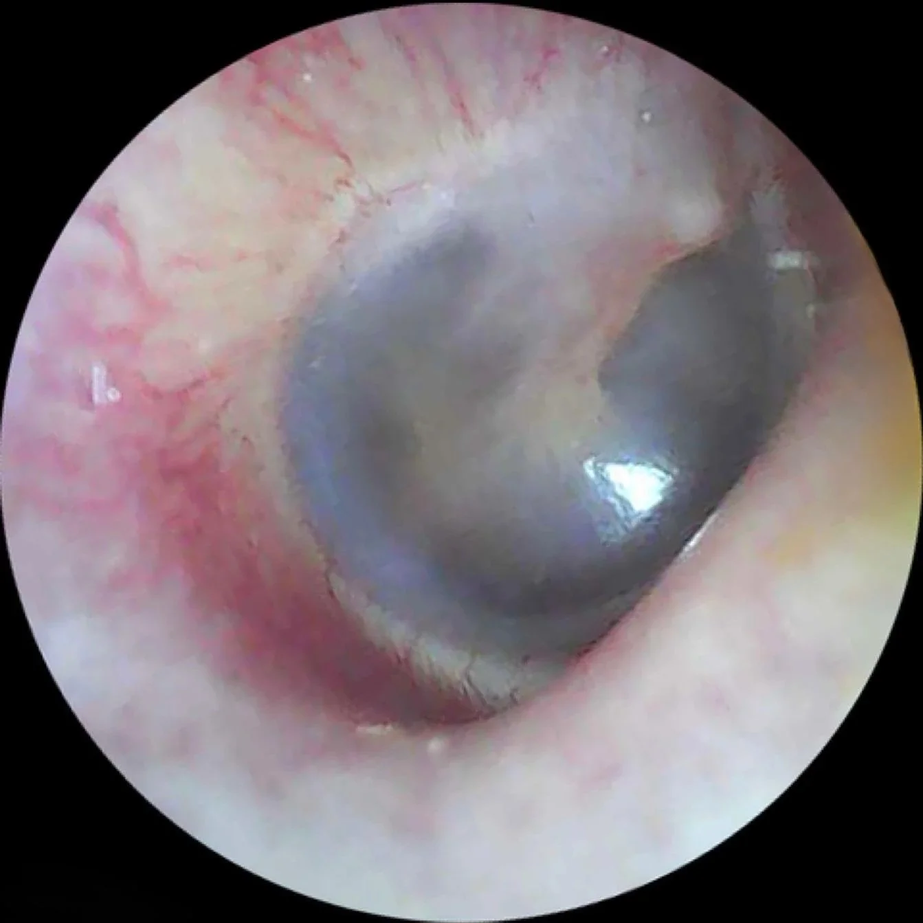 After microsuction ear wax removal showing a clear ear canal with trapped water released and a healthy, fully visible eardrum.