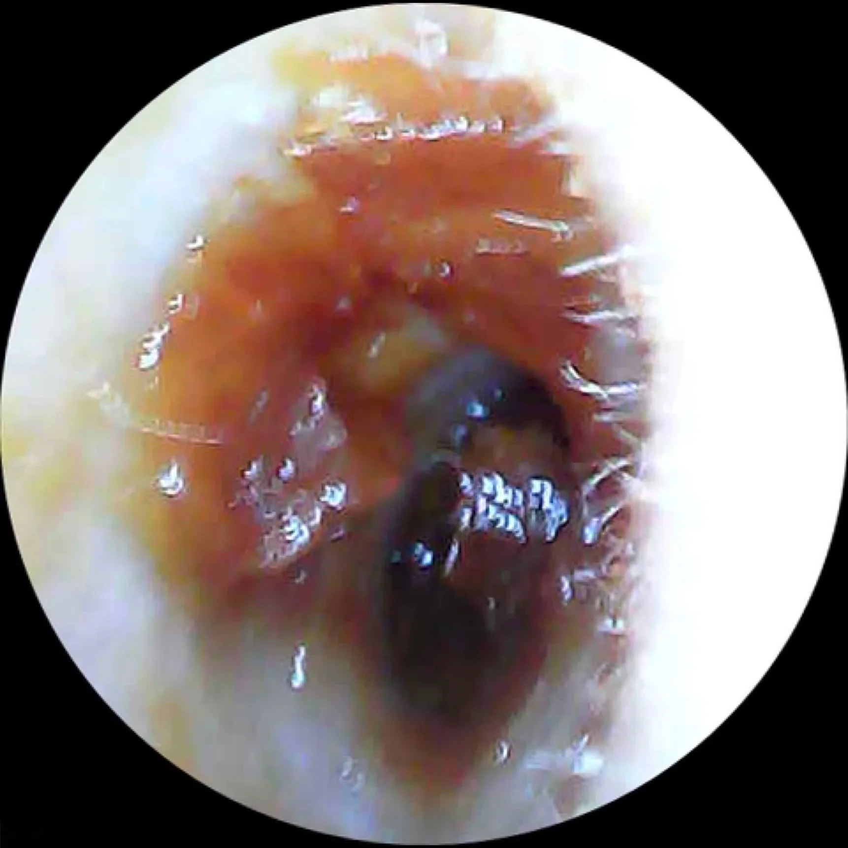 Before microsuction ear wax removal showing a dark, compact plug of earwax partially blocking the ear canal.